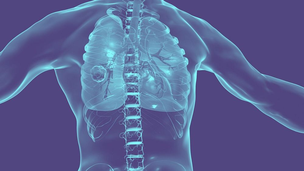 Un tentacule de robot pourrait révolutionner la façon dont nous détectons et traitons le cancer du poumon