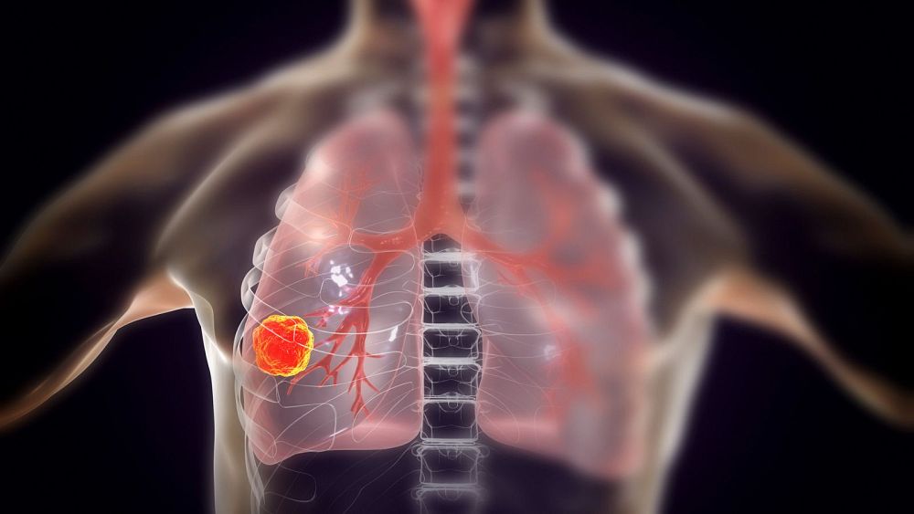 Un nouveau vaccin contre le cancer pourrait améliorer la survie des patients atteints de certains cancers du poumon (étude)