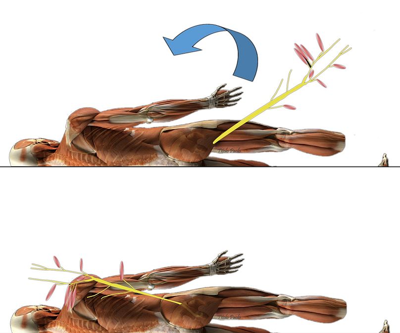 Les chirurgiens ont transféré une partie du nerf sciatique vers le plexus brachial du patient.