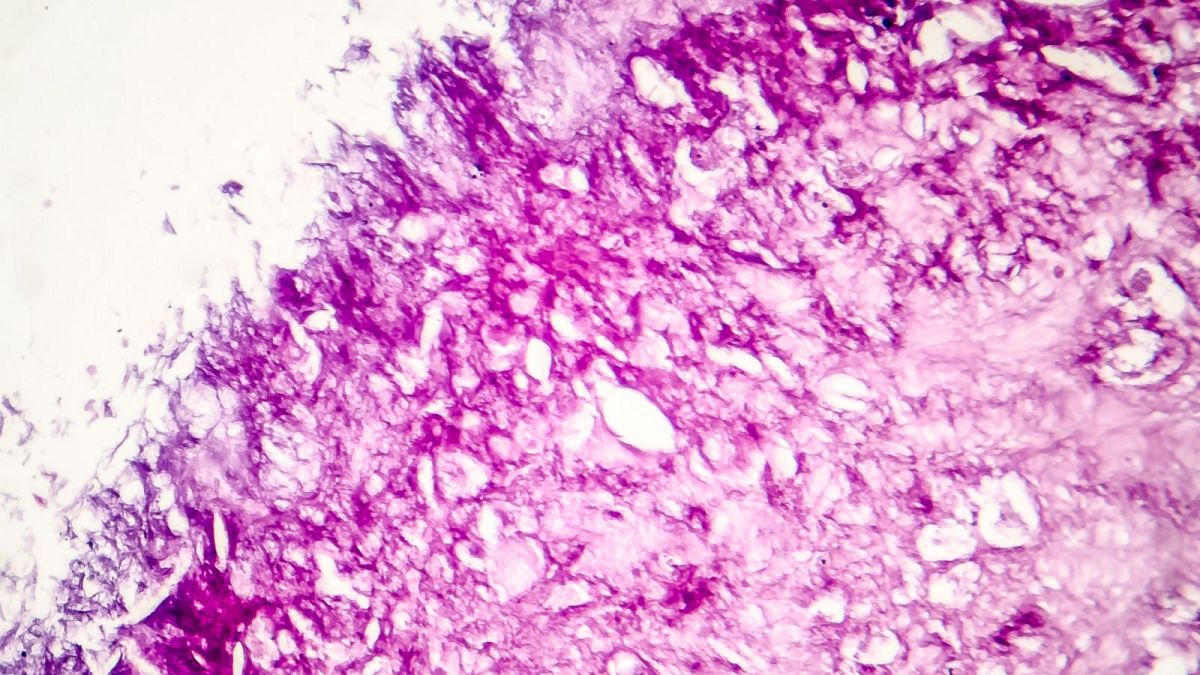 An example of melanoma cells.