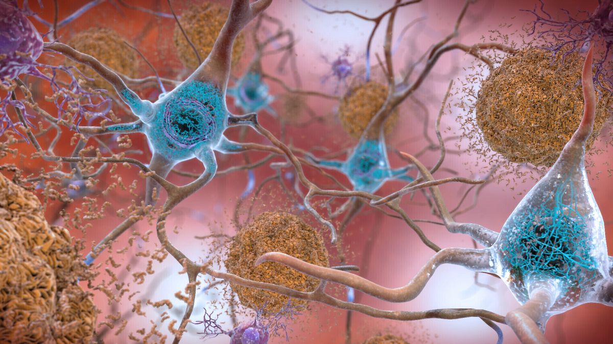 This illustration depicts cells in an Alzheimer’s affected brain, with abnormal levels of the beta-amyloid protein forming plaques, brown, that collect between neurons.