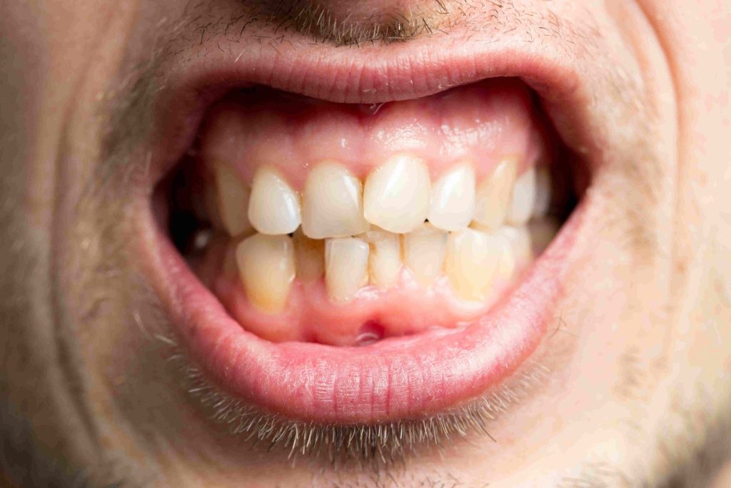 Les solutions de traitement pour les dents manquantes