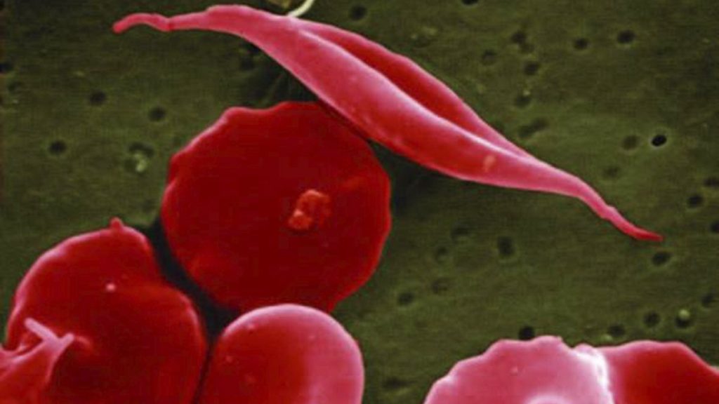 This electron microscope image provided by the National Institutes of Health in 2016 shows a blood cell altered by sickle cell disease, top.