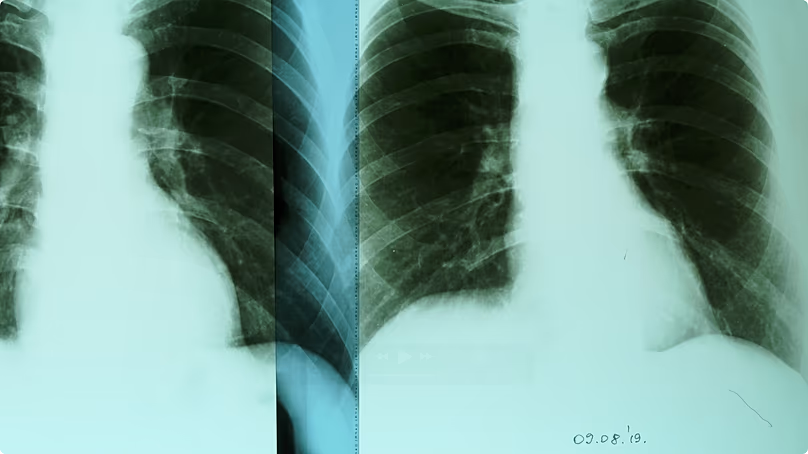 "Air pollution is a direct cause of lung cancer", says Senka Balorda.