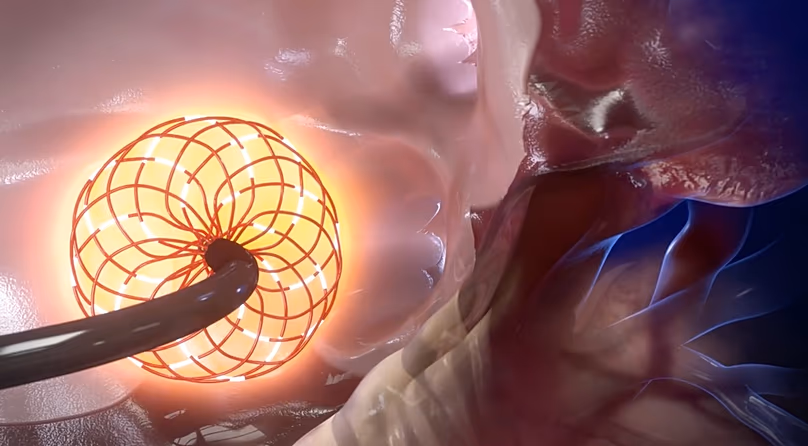 Animation informatique 3D du nouveau cathéter, actuellement en études cliniques