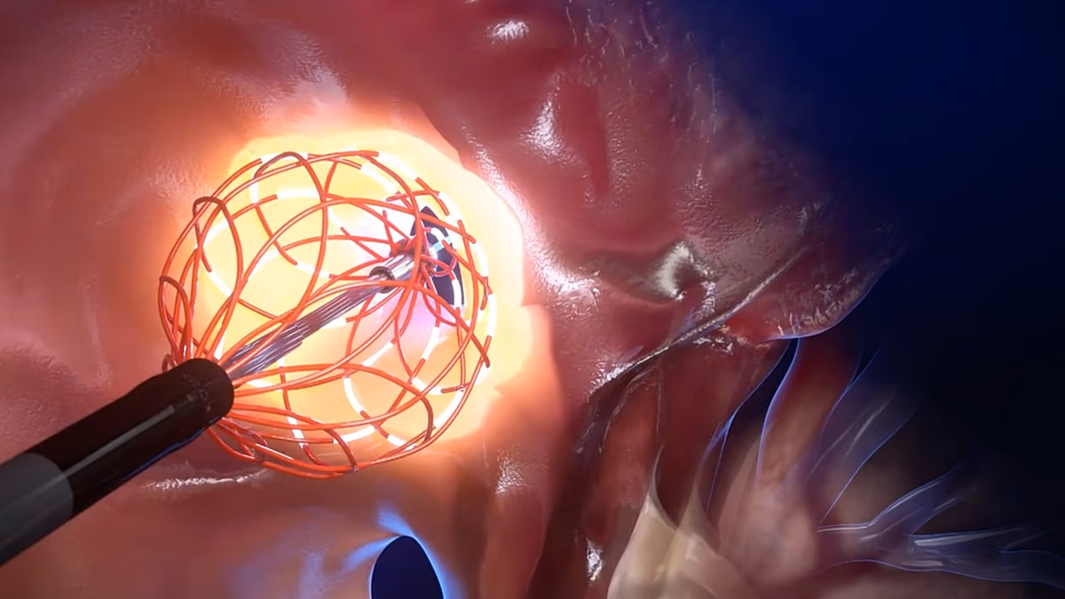 Au plus profond du cœur : le cathéter innovant conçu pour révolutionner le traitement de l'arythmie